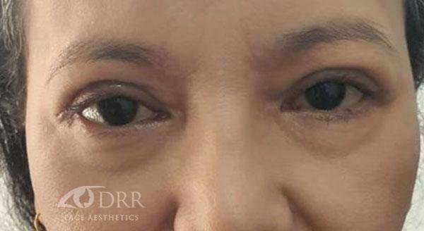 asian-blepharoplasty1-af