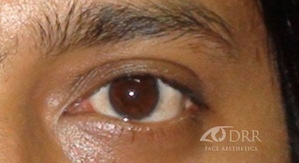 lower-lid-blepharoplasty1-af