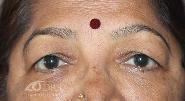 upper-blepharoplasty1-bf