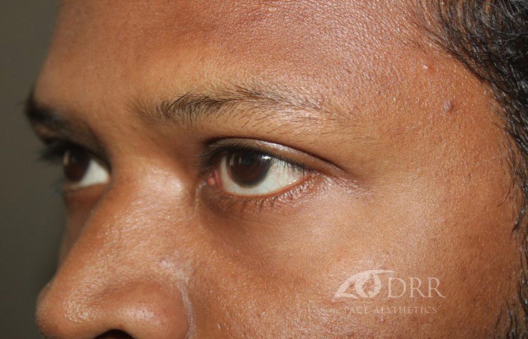 xanthelasma-after