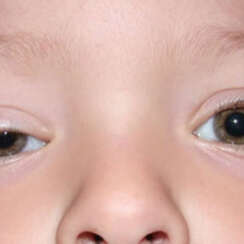 What is Eyelid Ptosis, What Causes It, and What are the Treatment Options?